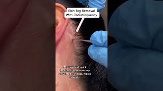 Skin Tag Removal With Radiofrequency  Quick amp Safe Treatment DRMEDISPA [upl. by Lugar447]