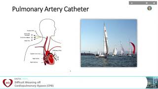 Haemodynamic and other Monitoring during weaning off CPB  Eric Benedet Lineburger Brasil [upl. by Anipsed326]