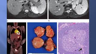 solid tumors of the peritoneum omentum and mesentery [upl. by Nimrak]