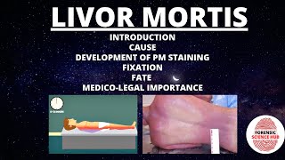 Livor mortis  Cause  Development  Fixation  Fate  Medicolegal importance  Forensic medicine [upl. by Manoop]