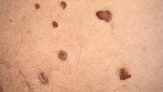 What is Skin Tags Acrochordon Causes Treatment [upl. by Akere]