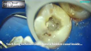 Upper first molar with 5 Canals [upl. by Fadas]