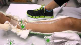 Emilys 5th Month Journey with Ewings Sarcoma [upl. by Maidel]