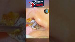 Dry earwax  Earwax causes ear blockage [upl. by Latsyk767]