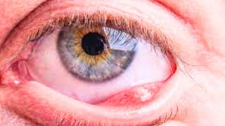 What is Chalazion Causes Symptoms Treatment [upl. by Rats]