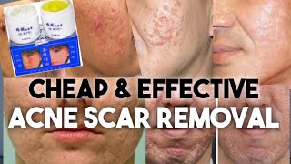 ACNE SCAR REMOVAL • Jiaoli Cream  Pimple  Acne Solution  Review [upl. by Eenattirb]