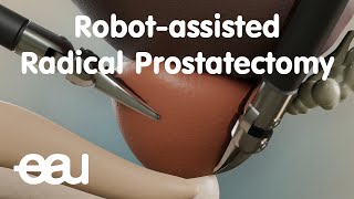 Robotassisted Radical Prostatectomy RARP [upl. by Langill]