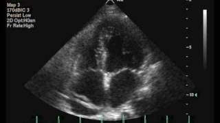 Interatrial septal aneurysm [upl. by Bruns]