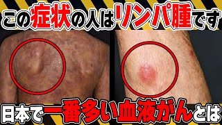 【日本で一番多い血液がん】絶対に見逃さないで！悪性リンパ腫の初期の危険サインとは？予防法についても医師が徹底解説！【医師監修】【悪性リンパ腫は】 [upl. by Leuneb]