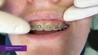 Orthodontic lacing [upl. by Supen]