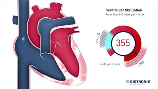 Fibrillazione ventricolare e morte cardiaca improvvisa [upl. by Siegel513]