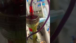 Plasmapheresis  YouTube viralshorts video [upl. by Dodie]