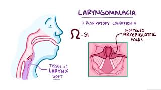 Bronchomalacia and Tracheomalacia [upl. by Hedda]