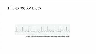 First degree AV block [upl. by Somerville]