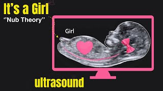 Its a baby girl 🤰 Nub theory  Ultrasound case2 [upl. by Wilton]