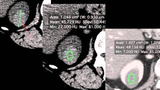 AULA Classificação de Bosniak de Cistos Renais  Renal Cysts Bosniak Classification [upl. by Reffotsirhc]