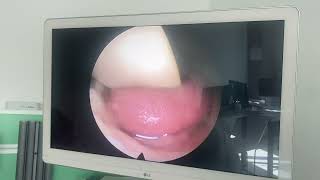 tonsil hypertrophytonsilenlargement [upl. by Harwill]