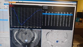 CSF Flow study in Philips3T Detalied explanation in Hindi Pat1avnishradiology [upl. by Fishbein]