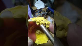 Pustiso na may Kawit Acrylic Denture [upl. by Thomajan]