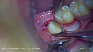 PIEZOSURGERY®  Dr Oreglia  Mandibular Impacted Third Molar Extraction with Piezo Technique [upl. by Bakerman]