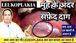 Munh ke Andar Safed Daag । White patches ।। Leukoplakia । क्यों ठीक नही होता है ये dramitkdubey [upl. by Llenwad268]