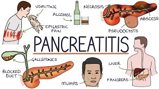 Understanding Pancreatitis [upl. by Lokkin]