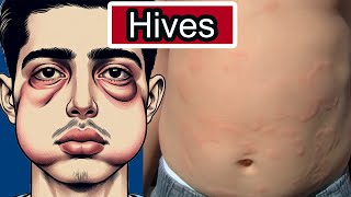 Hives Urticaria Explained Allergies Triggers and Relief Strategies [upl. by Atiragram]