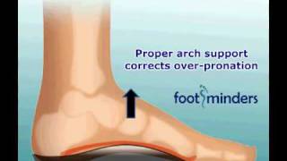 Foot Pain Due to Flat Feet and OverPronation An Easy Solution [upl. by Edwyna]