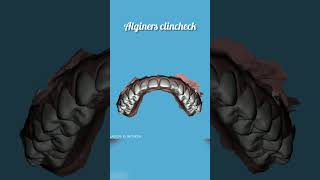 Alginers clincheck smiledental aligners alignersforteeth smile smiledesigndental orthodontics [upl. by Kenta279]