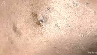 Big Cystic Acne Blackheads Extraction Blackheads amp Milia Whiteheads Removal Pimple Popping shorts [upl. by Doowrehs946]