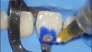 Class V composite Restoration  Direct anterior composite restoration [upl. by Amick]