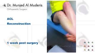 Anterior Cruciate Ligament ACL Reconstruction  1 week post surgery [upl. by Annaor]