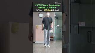 PRECICE Femur Lengthening 65cm [upl. by Franciscka]