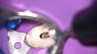 Ultraschall in der Endodontie [upl. by Anita]