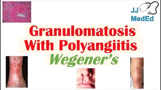 Granulomatosis with Polyangiitis Wegener’s granulomatosis  Symptoms Diagnosis Treatment [upl. by Anneis]