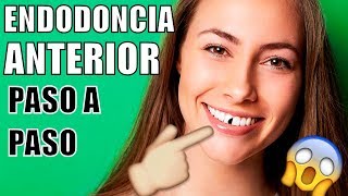 ENDODONCIA EN EL DIENTE DELANTERO ME ROMPÍ UN DIENTE COMO ES UNA ENDODONCIA COMO MTAR EL NERVIO [upl. by Zephaniah978]