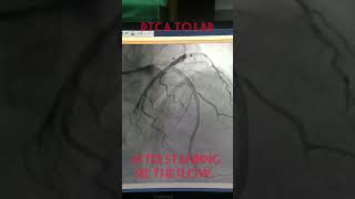 AngioplastyPTCA to LAD  coronary Stenting  Single Vessel disease alliedhealthsciences [upl. by Gwyneth]