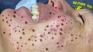 Blackheads l Acne treatment l Extraction cysts and blackheads l blackheads lips [upl. by Doerrer]