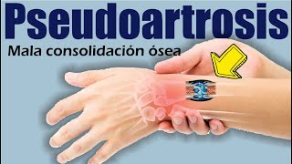 PSEUDOARTROSIS o Mala Consolidación de FRACTURAS 🥵 Falsa Articulación 🔴 Dr EDSON SERRANO Neomedica [upl. by Genevra]