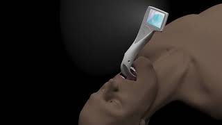 Introducing the iview™ video laryngoscope from Intersurgical [upl. by Nirrat]