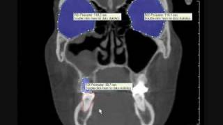 3D volume rendering DVT of female skull with maxillary sinusitis and dental cyst [upl. by Jeritah]