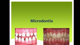 37Management of Microdontia [upl. by Karas497]