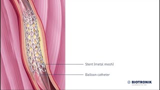 Angioplasty amp Stenting  Medical Animation [upl. by Wasson]