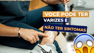 É possível ter varizes mesmo sem sintomas [upl. by Alurta242]