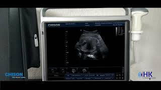 Chison EBit 50 Biometría fetal  Ultrasonido HK [upl. by Noled]