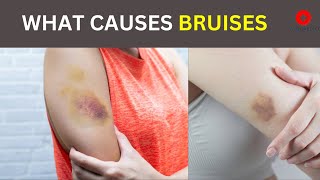 Bruises  Why does it happens  Symptoms Causes and treatment [upl. by Zeena]