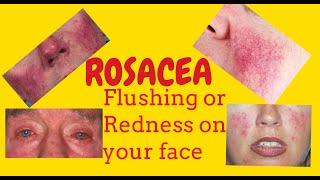 Rosacea or Potato nose or Rhinophyma or Redness of the face Phymatous rosacea Telangiectasia [upl. by Roinuj]