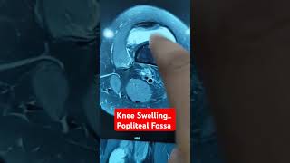 Knee Swelling Popliteal Fossa Dr Sai Chandra [upl. by Ener39]