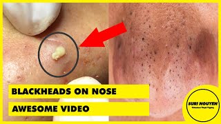 Suri 49 AWESOME BLACKHEADS ON NOSE [upl. by Prader]