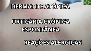 URTICÁRIA CRÔNICA ESPONTÂNEA  DERMATITE ATÓPICA  BIOTERAPIA  DUPILUMABE  STAPHYLOCOCCUS AUREUS [upl. by Rosario]